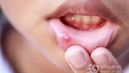 冬季“干燥上火”導(dǎo)致口腔潰瘍？四個細節(jié)要注意